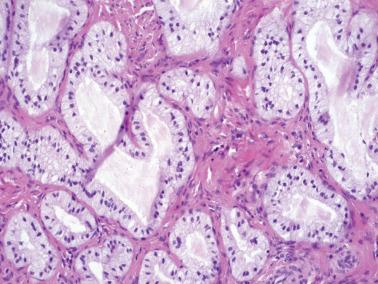 Fig. 4.49, Endocervical glandular hyperplasia, NOS. Occasional cases in this category have the appearance illustrated in which nuclei are centrally located with sub- and supranuclear clarity.