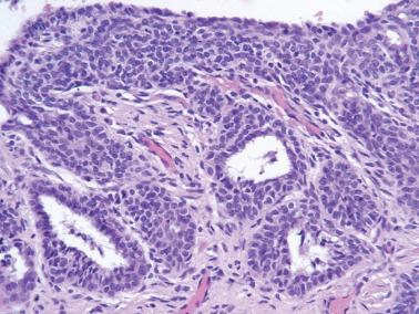 Fig. 4.50, Adenoid basal hyperplasia.