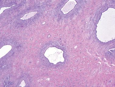 Fig. 4.5, Tubal metaplasia. Cellular stroma forms a prominent cuff around the glands, most of which are cystically dilated.