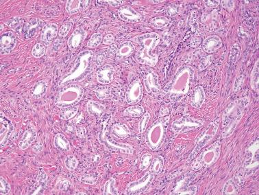 Fig. 4.53, Mesonephric hyperplasia. Tubules are lined by bland cuboidal epithelium and some characteristic eosinophilic material.
