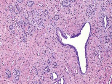 Fig. 4.54, Mesonephric hyperplasia. The tubules may become more compact and appear solid (top left).