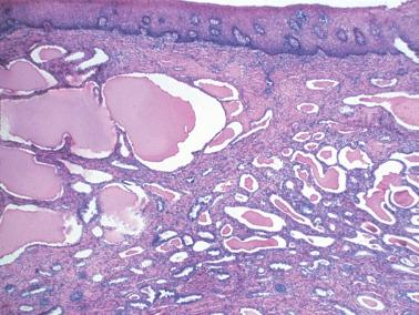 Fig. 4.55, Mesonephric hyperplasia. The tubules may be markedly dilated and extend close to the overlying epithelium. The picture here is somewhat reminiscent of tubulocystic clear cell carcinoma.