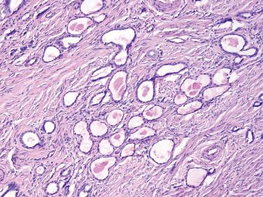 Fig. 4.56, Mesonephric hyperplasia. Small dilated tubules some lined by flattened epithelium may be seen and can mimic clear cell carcinoma.