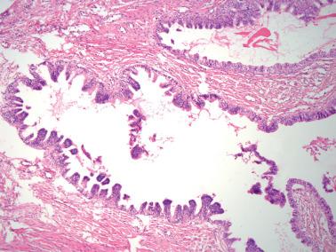Fig. 4.57, Mesonephric duct hyperplasia. Two large ducts are focally lined by tufted epithelium.