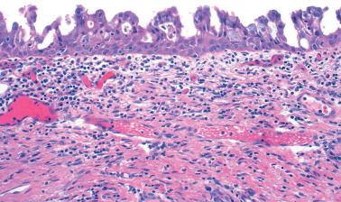 Fig. 4.60, Post-procedure tufting. A prior procedure has caused relatively uniform tufts of epithelial cells to replace the cervical mucosa.