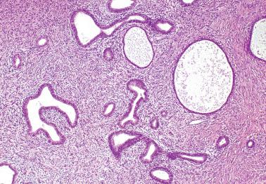 Fig. 4.6, Tubal metaplasia. The glands vary in size and shape, and some are cystic. The periglandular stroma is more cellular than normal endocervical stroma.