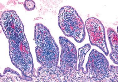 Fig. 4.63, Papillary endocervicitis.