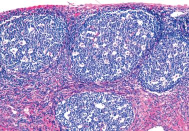 Fig. 4.64, Follicular cervicitis.