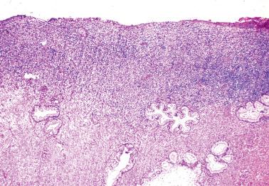 Fig. 4.65, Florid reactive lymphoid hyperplasia (lymphoma-like lesion). There is a band-like cellular infiltrate that has a well-circumscribed deep border with the underlying endocervical stroma.