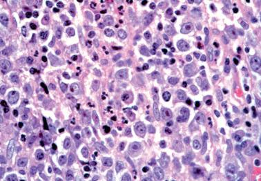 Fig. 4.66, Florid reactive lymphoid hyperplasia (lymphoma-like lesion). Note admixture of cell types including immunoblasts, some of which exhibited mitotic figures (not shown).