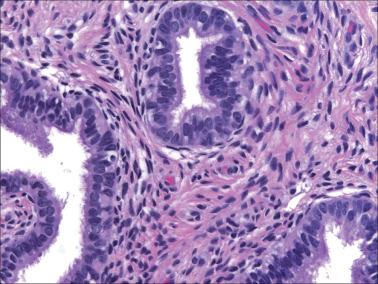 Fig. 4.7, Tubal metaplasia. Most of the epithelial cells are ciliated.