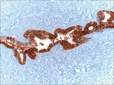 Fig. 4.8, Tubal metaplasia, p16 immunostain. This process may show strong positivity in some cases, but staining is not uniform (see left of image).