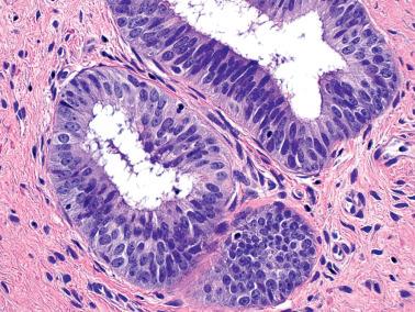 Fig. 4.9, Tuboendometrioid metaplasia. Two glands show marked pseudostratification with admixed ciliated and nonciliated cells.