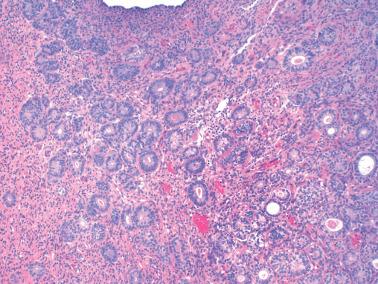 Fig. 4.10, Endometrioid metaplasia.