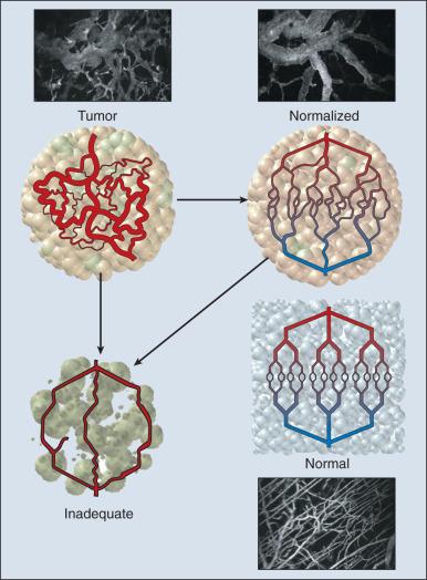 Figure 8.4, Normalization of tumor vasculature. Normal vessels are well organized with even diameters. In contrast, tumor vessels are tortuous, with increased vessel diameter, length, density, and permeability. Antiangiogenic therapies “normalize” the tumor vascular network and could ultimately reduce the vasculature to the point at which it provides inadequate support for oxygen and drug delivery.