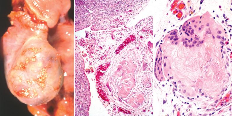 Fig. 20.1, Keratin granuloma involving ovarian serosa in a patient with an endometrial endometrioid adenocarcinoma with squamous differentiation. Left: Gross appearance. Center: Keratin granuloma (right) on ovarian surface (left). Right: Higher-power view showing ghost outlines of necrotic squamous cells.