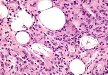 Fig. 20.11, Vernix caseosa peritonitis. There is a granulomatous response to flakes of keratin (bottom center of field).