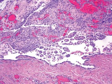 Fig. 20.13, Mesothelial hyperplasia. Two main patterns of this process are seen – a sheet-like growth (left of center) and papillae.