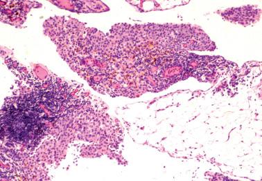 Fig. 20.14, Mesothelial hyperplasia. Circumscribed aggregates of mesothelial cells involve the surface of the omentum.