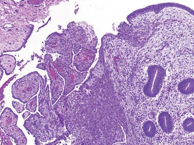 Fig. 20.15, Mesothelial hyperplasia. A slightly complex papillary proliferation is seen adjacent to endometriosis, the latter a major clue to the papillary process being reactive.