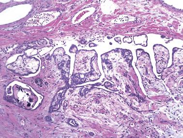 Fig. 20.16, Mesothelial hyperplasia. Papillary to polypoid projections are seen and are associated with bland mesothelial tubules.