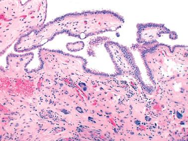 Fig. 20.17, Mesothelial hyperplasia. Papillae covered by bland mesothelial cells are seen. Note the stromal giant cells, which are occasionally seen in such reactive processes.