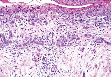 Fig. 20.18, Mesothelial hyperplasia within entrapment of mesothelial cells within reactive fibrous tissue. Note linear arrangement of entrapped cells that parallel the surface.