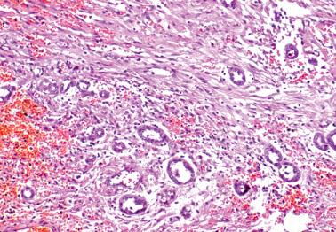 Fig. 20.19, Mesothelial hyperplasia within wall of endometriotic cyst. Small mesothelial tubules are irregularly distributed within reactive fibrous tissue.