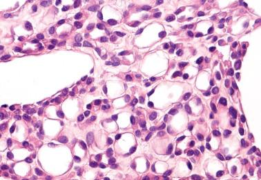 Fig. 20.20, Hyperplastic mesothelial cells with prominent cytoplasmic vacuoles, resulting in a signet-ring-like appearance.