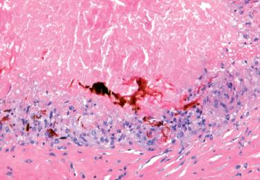 Fig. 20.2, Postcautery necrotic granuloma of peritoneum.