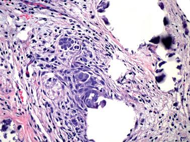 Fig. 20.21, Mesothelial hyperplasia with small papillae and foci of calcification. In some cases, the papillae may raise concern for a serous neoplasia (borderline or low-grade carcinoma).