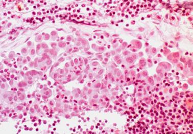 Fig. 20.22, Hyperplastic mesothelial cells occupy a subcapsular sinusoid within a pelvic lymph node.