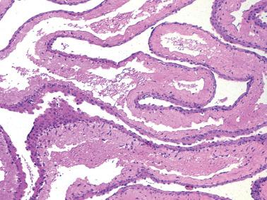 Fig. 20.25, Multilocular peritoneal inclusion cyst. The typical convoluted pattern is seen. The mesothelial lining varies from a single layer to multilayered and focally squamous in character.