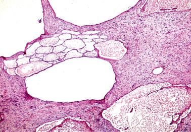 Fig. 20.26, Multilocular peritoneal inclusion cyst. Multilocular peritoneal inclusion cyst. Multiple variably sized cystic spaces are separated by a reactive fibrous stroma.