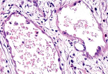 Fig. 20.28, Multilocular peritoneal inclusion cyst. Spaces are lined by flattened to cuboidal mesothelial cells with mild nuclear atypia.