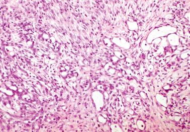 Fig. 20.29, Multilocular peritoneal inclusion cyst. An area resembling an adenomatoid tumor is depicted.