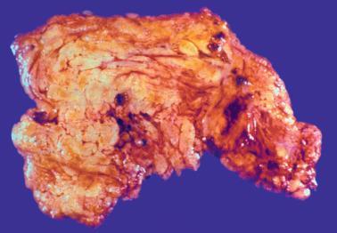 Fig. 20.30, Splenosis. Omentectomy specimen contains several reddish-purple nodules that on histologic examination were composed of splenic tissue.