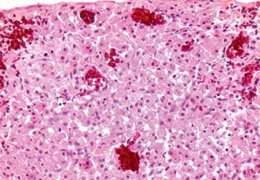 Fig. 20.3, Peritoneal histiocytic infiltrate.