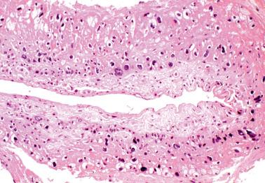 Fig. 20.31, Peritoneal placental site plaque.