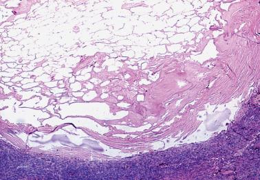 Fig. 20.32, Infarcted appendix epiploica.