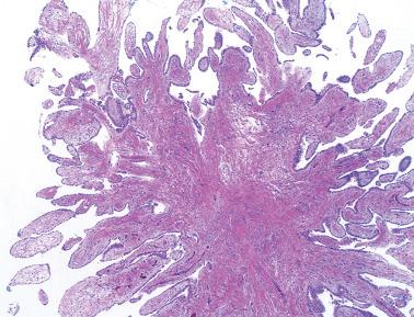 Fig. 20.33, Well-differentiated papillary mesothelioma. Note the lack of penetration of mesothelial cells into the stromal compartment of the lesion, as is typically seen in malignant mesothelioma.