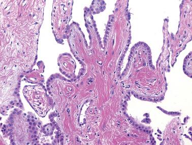 Fig. 20.34, Well-differentiated papillary mesothelioma. Note the innocuous appearance of the mesothelial cells covering the papillae.