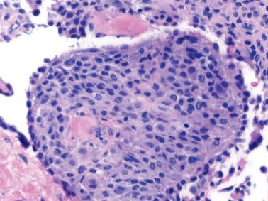 Fig. 20.4, Peritoneal histiocytic nodule. A circumscribed focus of histiocytes is seen on the peritoneal surface.