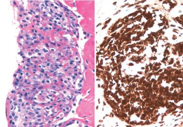 Fig. 20.5, Peritoneal histiocytic nodule. Left: H&E. Right: CD68 stain.