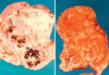 Fig. 20.6, Peritoneal melanosis associated with a dermoid cyst of the ovary. There is brown pigmentation of the lining of the dermoid cyst (left panel) and the omentum (right panel, lower left corner).