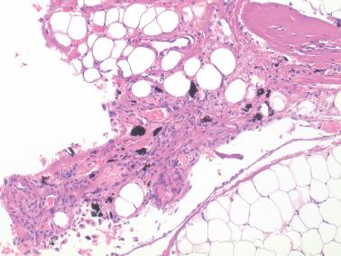 Fig. 20.8, Peritoneal pigmentation. The material in this case appeared brown–black at operation. The material failed to stain for melanin or iron. The exact nature of the material is unclear. The patient had Peutz–Jeghers syndrome.