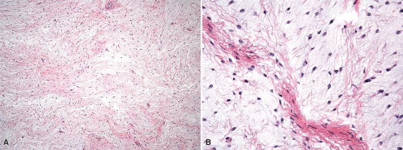 Figure 5.3, Cellular Myxoma.