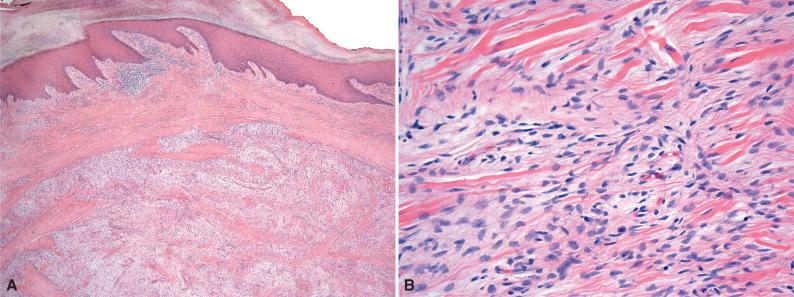 Figure 5.6, Superficial Acral (Digital) Fibromyxoma.