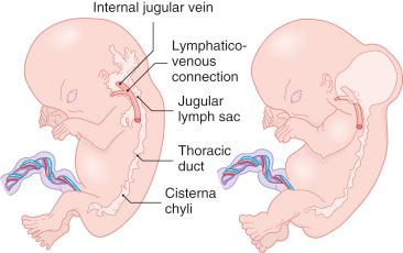 Fig. 23.1, Proposed Mechanism for Formation of Lymphatic Malformation.