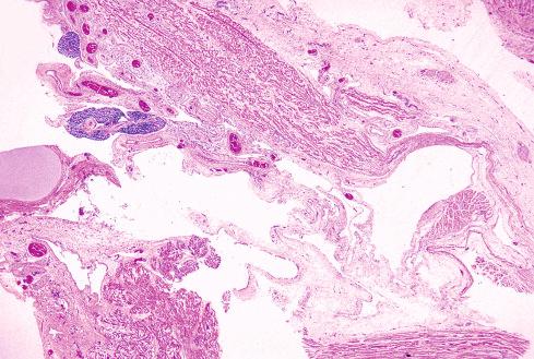 Fig. 23.5, Macrocystic lymphatic malformation (cystic hygroma) from fetus with Turner syndrome.